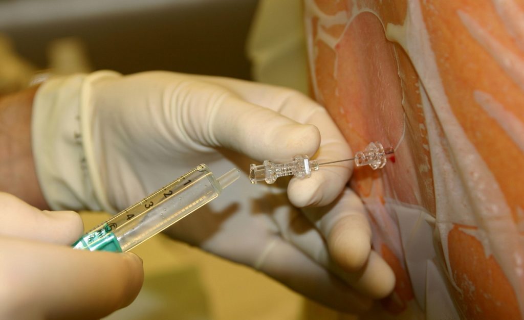 Eine Nahaufnahme einer Flasche mit Liquor für eine Lumbalpunktion zur Diagnose der Multiplen Sklerose.